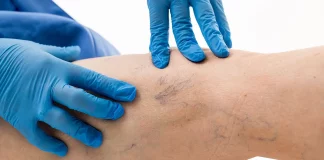 ¿Tienes claro cómo se puede evitar una trombosis? El riesgo de trombosis se puede atenuar con un modo de vida saludable.