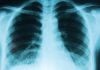 Atajar el cáncer de pulmón será más probable desde el 1 de enero en Castilla-La Mancha pulmones