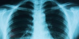 Atajar el cáncer de pulmón será más probable desde el 1 de enero en Castilla-La Mancha pulmones