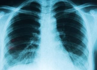 Atajar el cáncer de pulmón será más probable desde el 1 de enero en Castilla-La Mancha pulmones