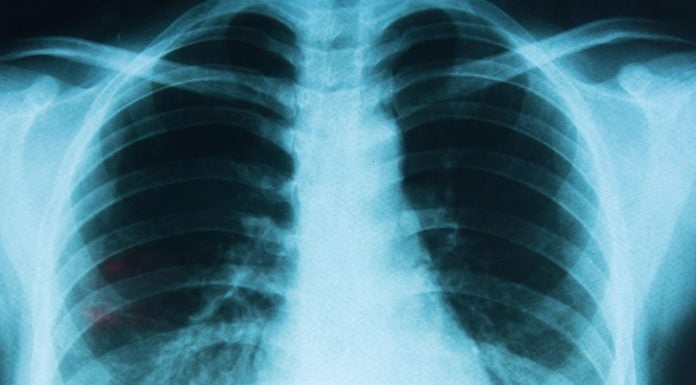Atajar el cáncer de pulmón será más probable desde el 1 de enero en Castilla-La Mancha pulmones