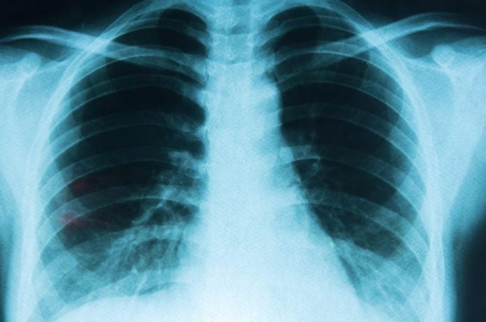 pulmones